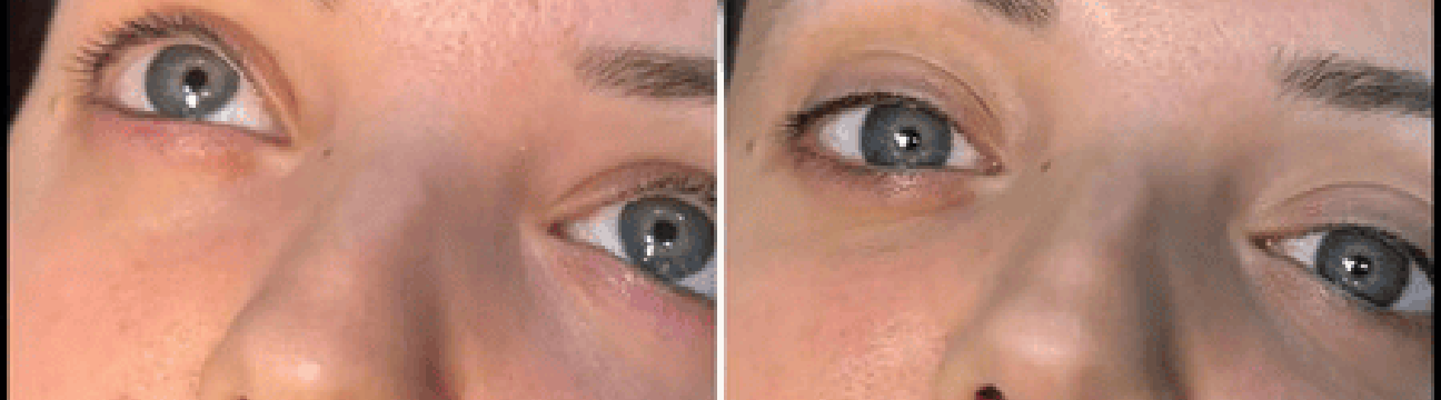 Dermal Fillers